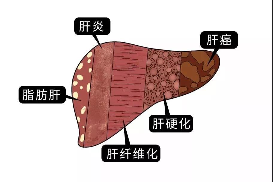 脂肪肝的最大敵人不是肥胖，答案竟是這樣！