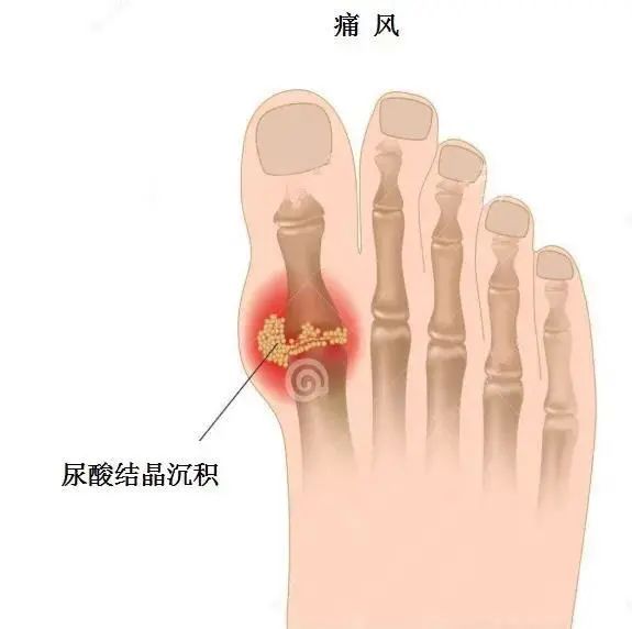 痛風(fēng)為什么偏愛男性？你最關(guān)心的問題都在這里