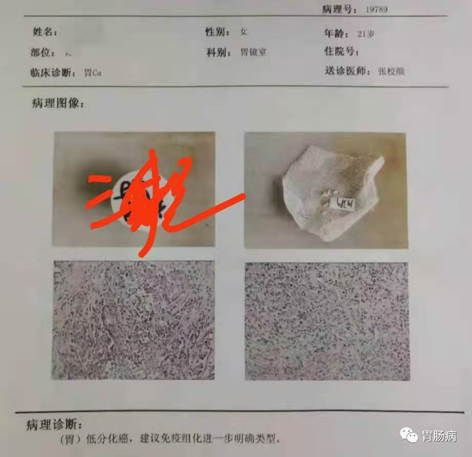 醫(yī)生總結了3位年輕胃癌患者的病例：30歲不到的他們到底干啥了？