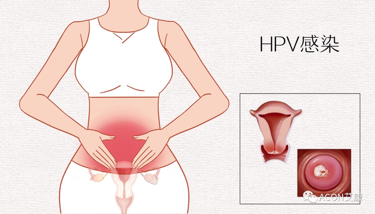 HPV轉(zhuǎn)陰其實很簡單， 女性必知的宮頸癌真相