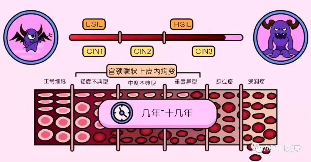HPV轉(zhuǎn)陰其實很簡單， 女性必知的宮頸癌真相