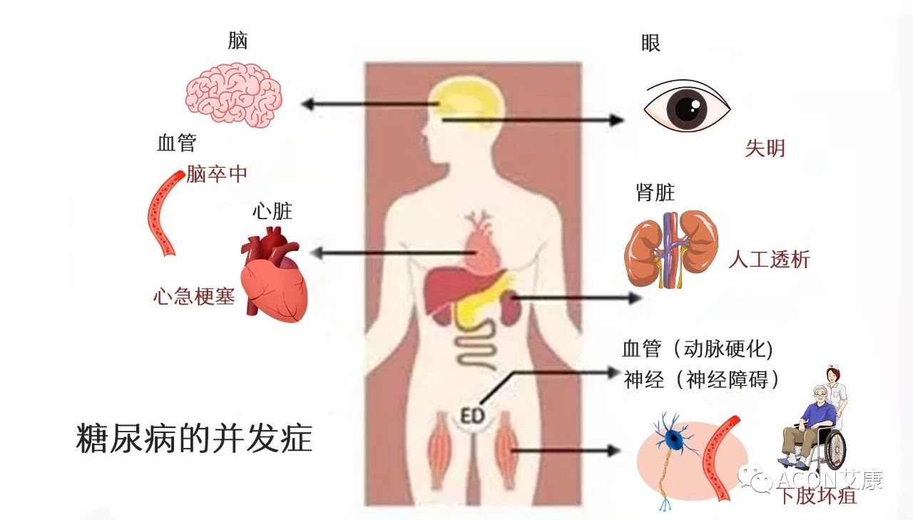 爆上熱搜，因爆發(fā)型糖尿病進入ICU，有哪些教訓值得我們汲取