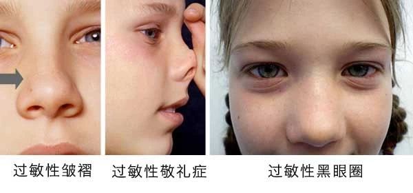 過(guò)敏性鼻炎會(huì)讓孩子變傻？！家長(zhǎng)該如何應(yīng)對(duì)